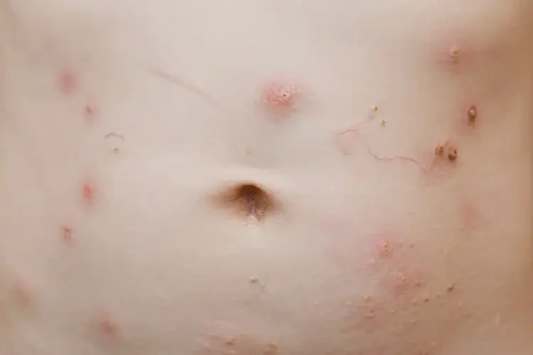 兒童肚子上有濕疹不管它會自己痊愈嗎(圖4)