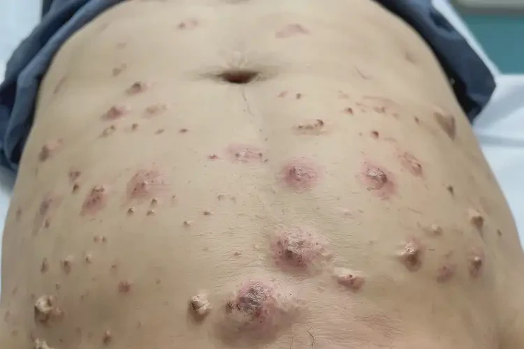 男人肚子上經(jīng)常長濕疹能徹底自愈嗎(圖4)