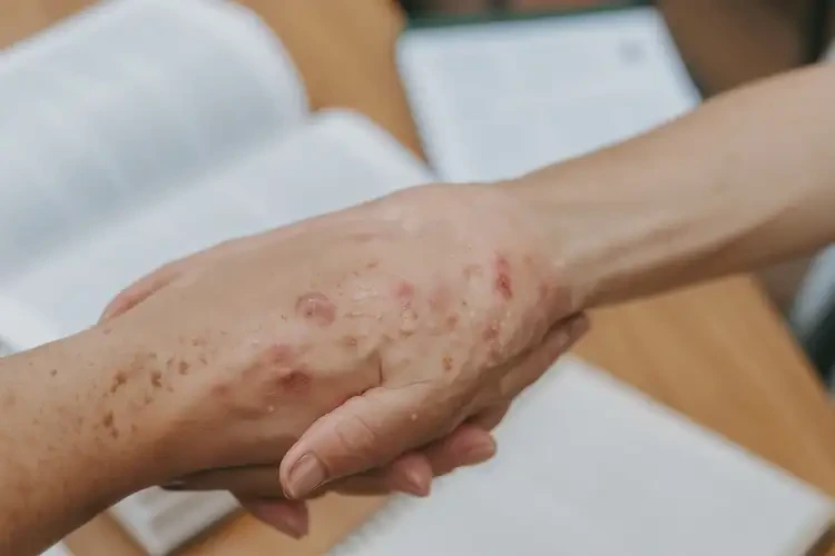 大學(xué)生手上長濕疹能不能徹底自愈(圖4)