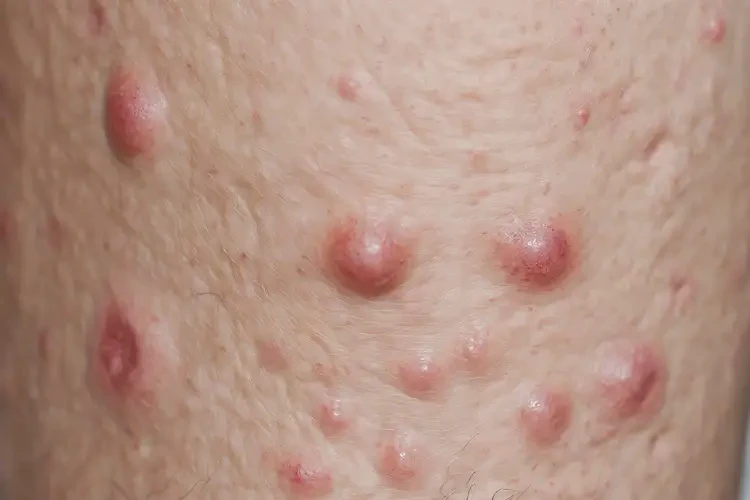 老人大腿上出濕疹能徹底自愈嗎(圖4)