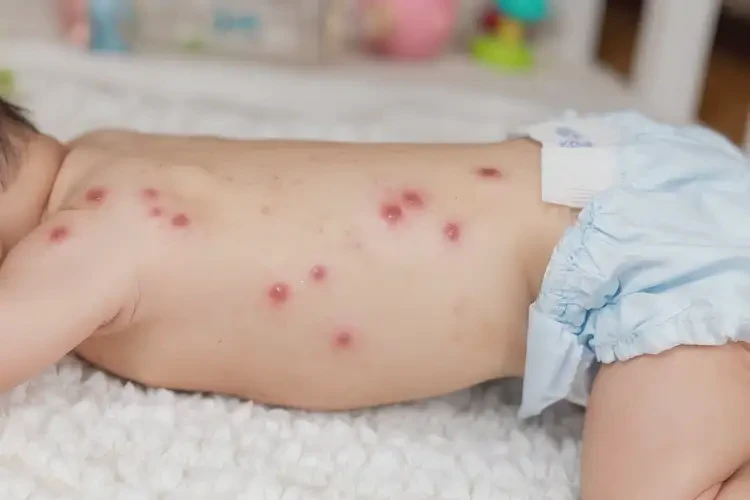 寶寶屁股偶爾長濕疹能夠徹底治愈嗎(圖4)