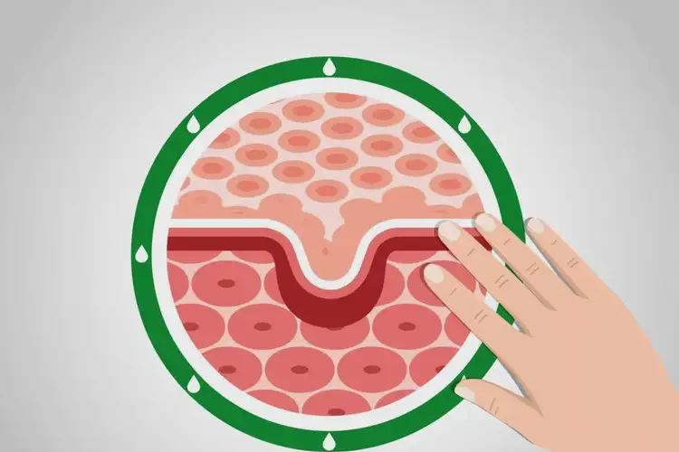 男性肛周起濕疹能徹底自愈嗎(圖1)