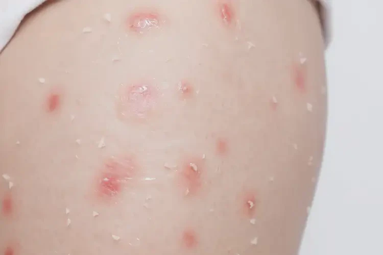 小孩大腿上偶爾長(zhǎng)濕疹不管它會(huì)自己痊愈嗎(圖1)