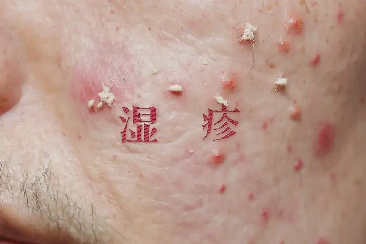 男人面部經(jīng)常長濕疹不管它會自己自愈嗎(圖4)