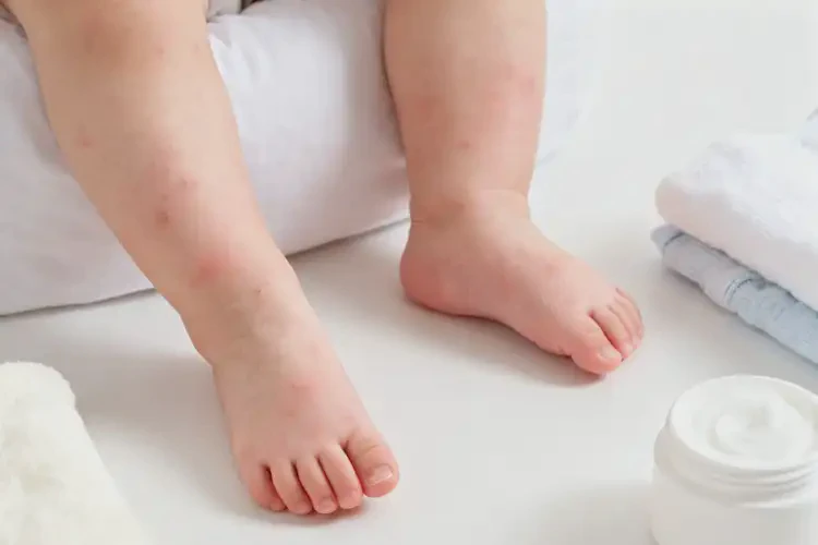 幼兒四肢有濕疹可不可以徹底自愈(圖3)