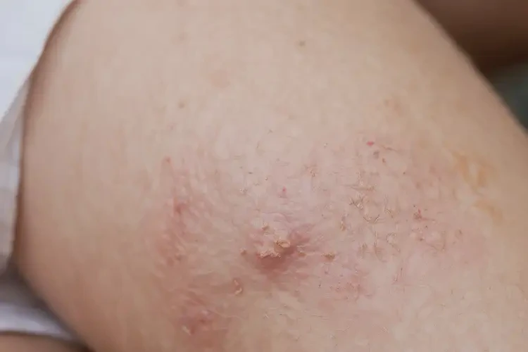 小孩大腿上偶爾長(zhǎng)濕疹不管它會(huì)自己痊愈嗎(圖3)