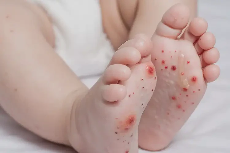 小兒腳上容易長濕疹可以徹底自愈嗎(圖4)