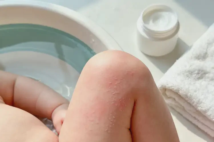 新生兒大腿起濕疹能靠自己自愈嗎(圖1)