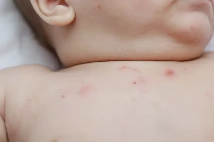 寶寶脖子容易長(zhǎng)濕疹不管它會(huì)自己痊愈嗎(圖4)