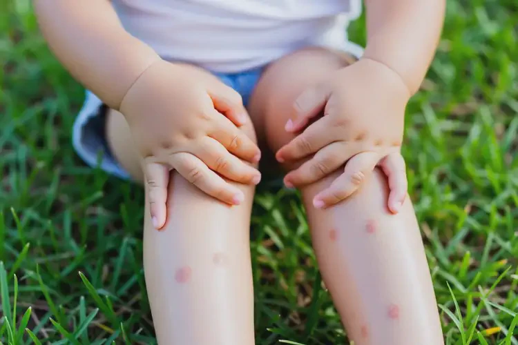 小孩四肢經(jīng)常起濕疹不管它會自己好嗎(圖2)