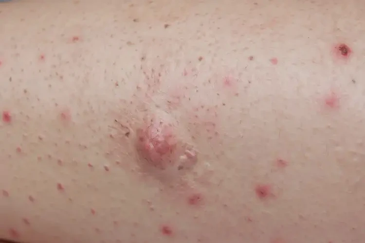 產婦大腿上出現(xiàn)濕疹不管它會自己痊愈嗎(圖4)