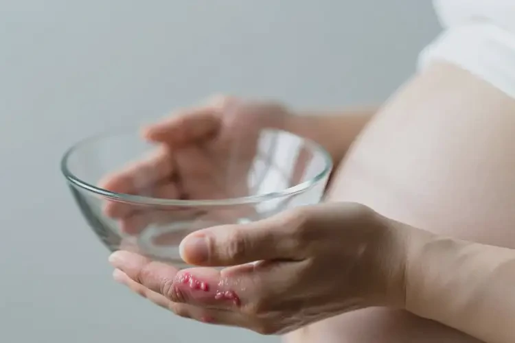 產(chǎn)婦手上經(jīng)常起濕疹能徹底自愈嗎(圖1)