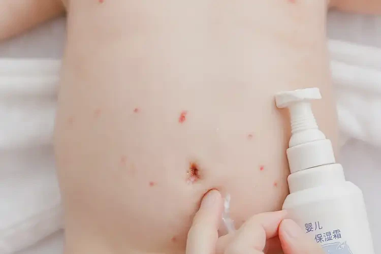 新生兒肚子上偶爾長濕疹能靠自己自愈嗎(圖3)