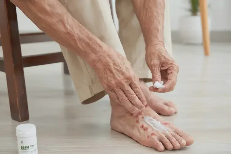 老人腳上起濕疹能徹底自愈嗎(圖3)
