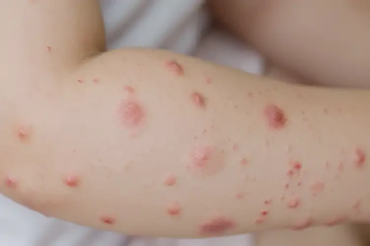 兒童屁股容易起濕疹不管它會(huì)自己痊愈嗎(圖4)