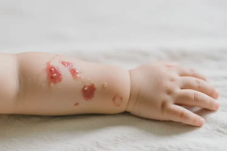 幼兒手臂上有濕疹能不能徹底自愈(圖3)