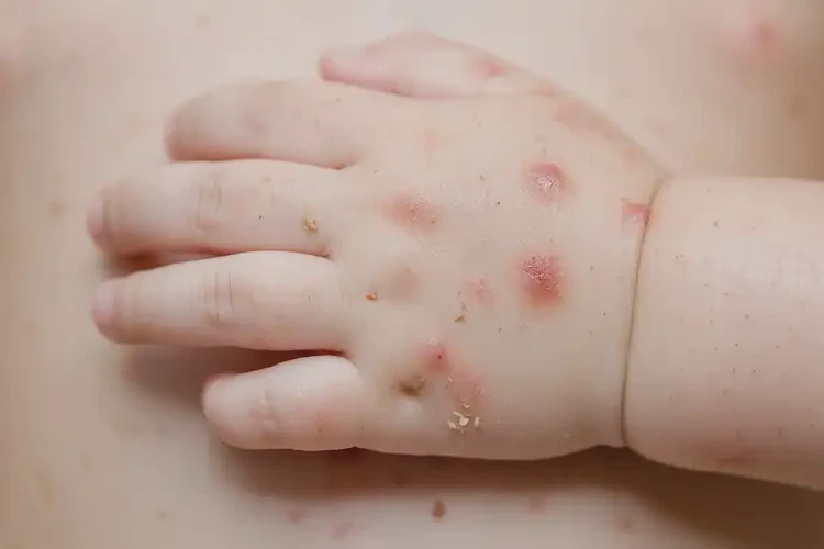 孩子手上長(zhǎng)濕疹不管它會(huì)自己痊愈嗎(圖4)