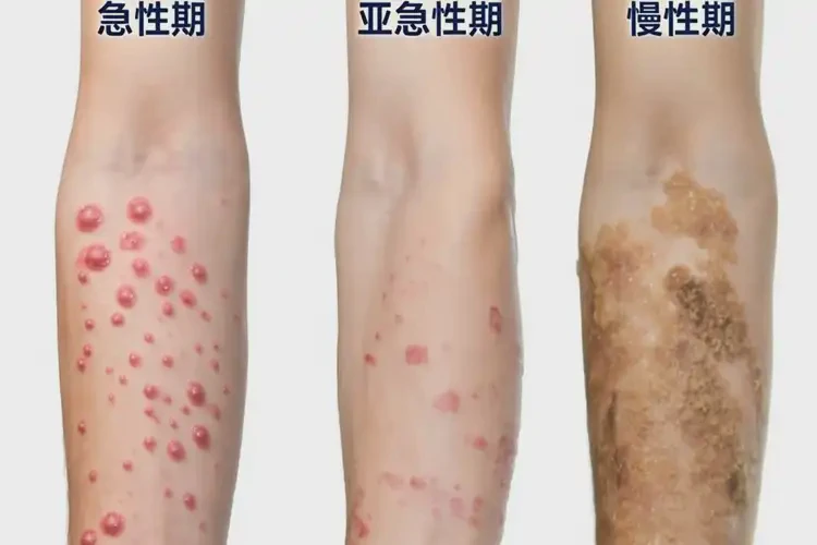 男人脖子偶爾長濕疹不管它會自己好嗎(圖3)