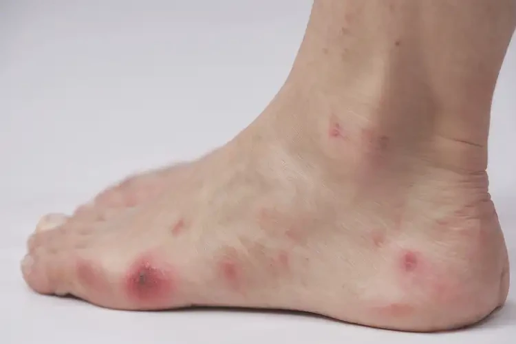 女生腳上出濕疹能靠自己自愈嗎(圖4)