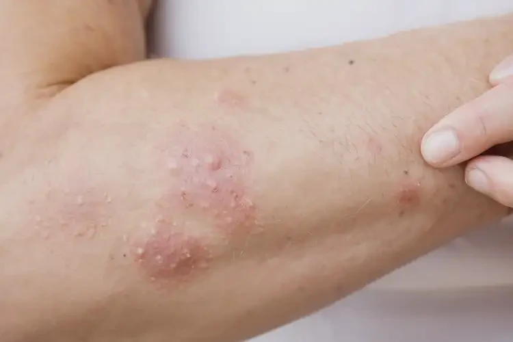 中学生肚子容易长湿疹可不可以彻底自愈(图4)