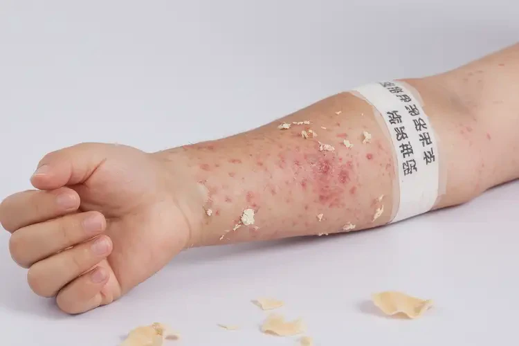 小兒手臂上容易起濕疹不管它會(huì)自己痊愈嗎(圖3)