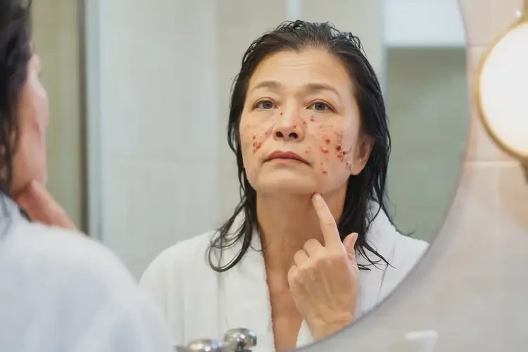 中学生身上偶尔起湿疹可以彻底自愈吗(图4)