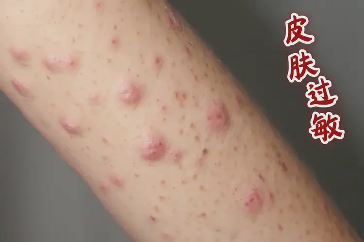 女人手臂經(jīng)常長濕疹可不可以徹底自愈(圖4)