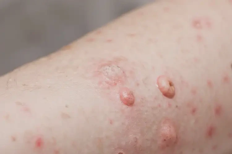 小孩屁股上出濕疹能夠徹底治愈嗎(圖4)