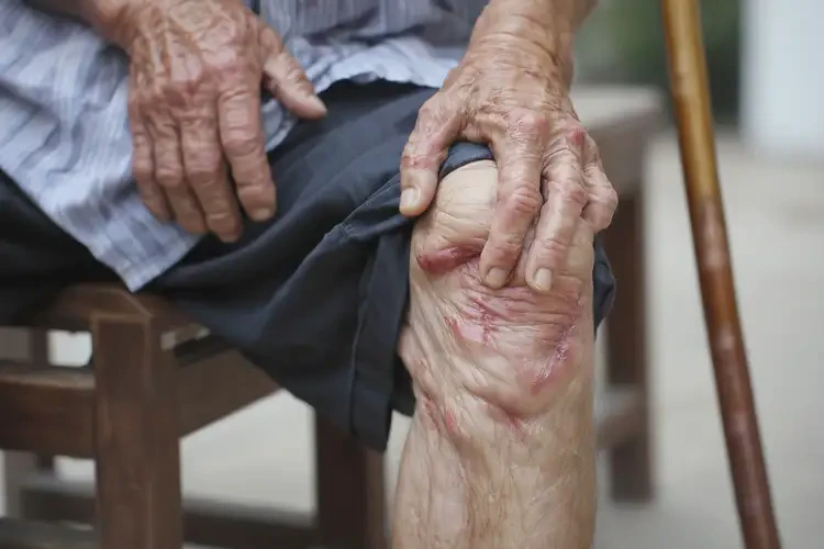 高齡老人小腿上偶爾長濕疹不管它會自己好嗎(圖4)