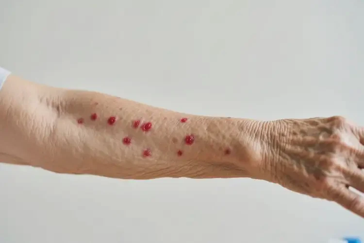 老年人手臂上出濕疹不管它會(huì)自己好嗎(圖4)