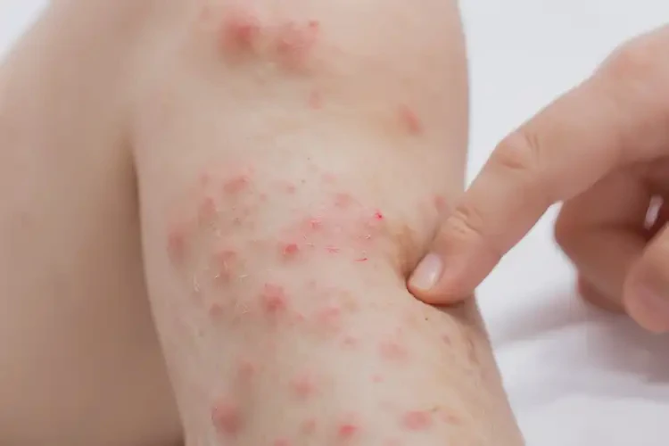 孩子四肢經(jīng)常長濕疹不管它會自己自愈嗎(圖4)