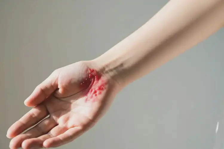 女性手臂上出湿疹能靠自己自愈吗(图4)