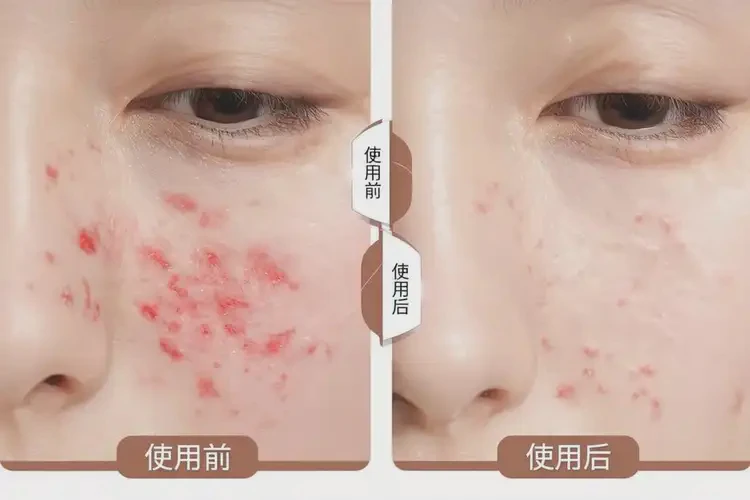 新生兒臉上偶爾起濕疹能徹底自愈嗎(圖4)