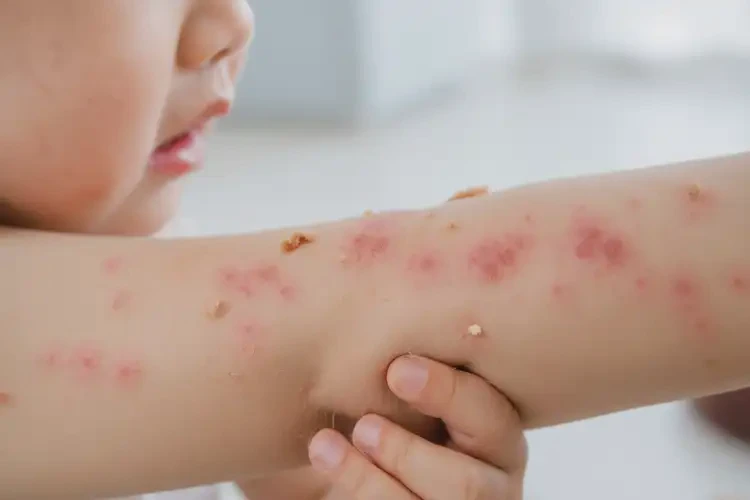 孩子手臂經(jīng)常起濕疹能夠徹底治愈嗎(圖4)