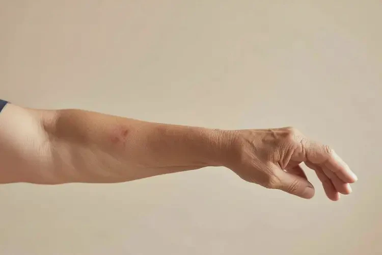 老年人手臂上偶爾起濕疹可以徹底自愈嗎(圖4)