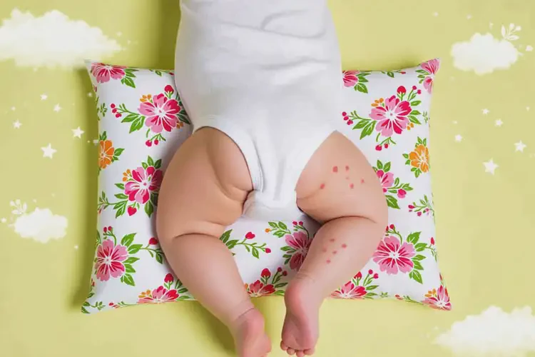 幼兒屁股經(jīng)常起濕疹可不可以徹底自愈(圖3)