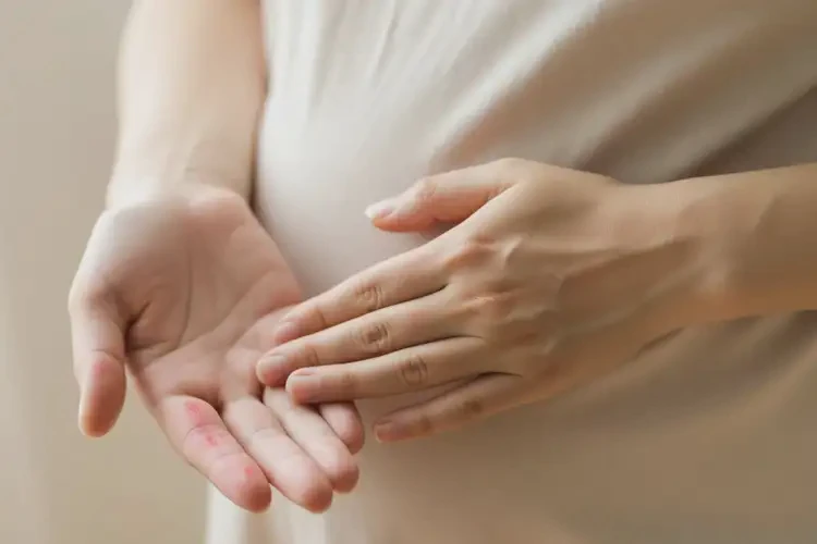孕婦手上偶爾長濕疹可不可以徹底自愈(圖4)
