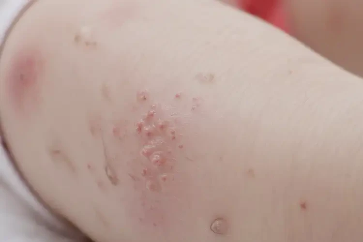 寶寶小腿上經(jīng)常長濕疹能靠自己自愈嗎(圖4)