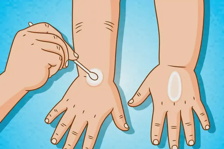 幼兒手臂偶爾長濕疹能夠徹底治愈嗎(圖4)