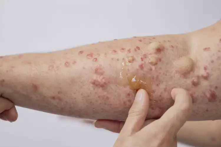 男人全身经常长湿疹不管它会自己好吗(图3)