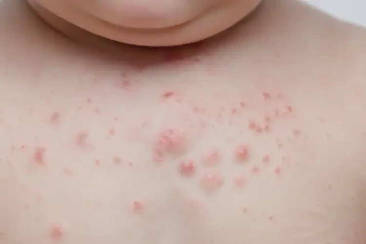 寶寶脖子上偶爾起濕疹能徹底自愈嗎(圖4)