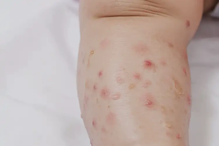 寶寶大腿上長濕疹能靠自己自愈嗎(圖3)