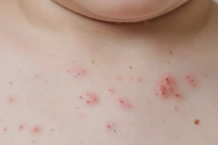 小兒脖子容易長濕疹能徹底自愈嗎(圖4)