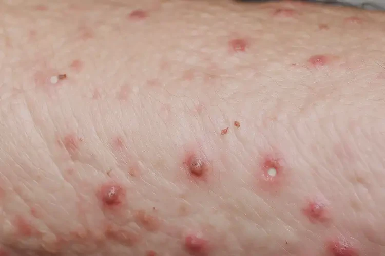 老年人手臂上偶爾起濕疹可不可以徹底自愈(圖4)