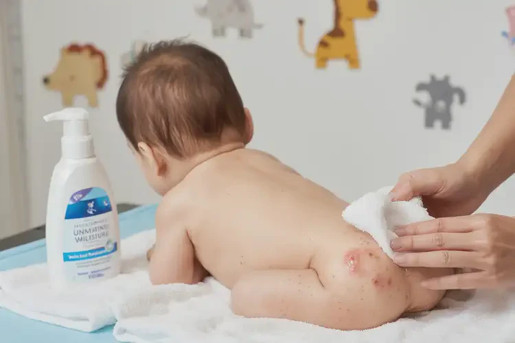 寶寶屁股有濕疹可不可以徹底自愈(圖3)