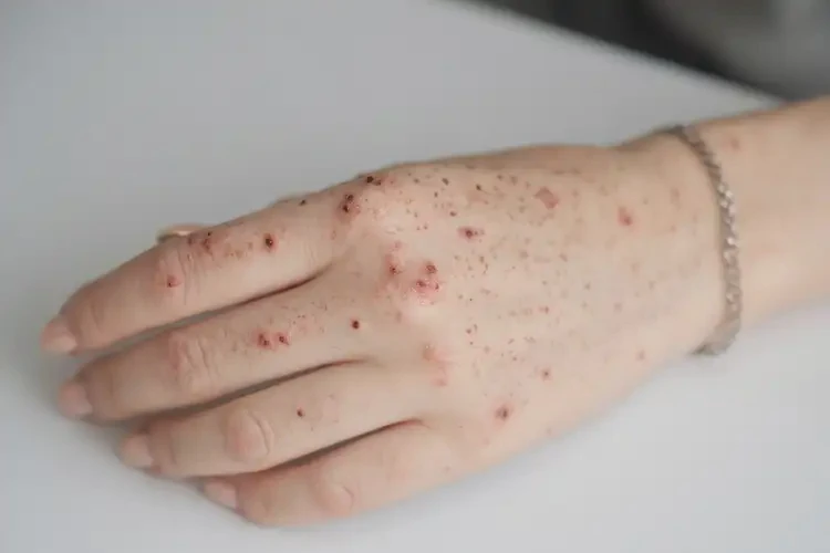 女生手上偶爾起濕疹可不可以徹底自愈(圖4)