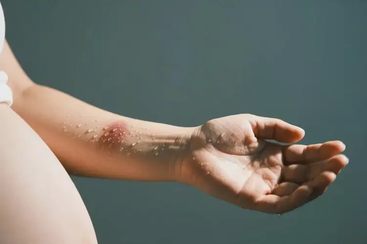 產(chǎn)婦手臂上起濕疹不管它會自己痊愈嗎(圖2)