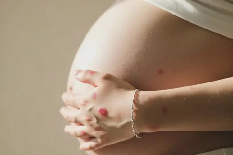 孕婦手上偶爾起濕疹不管它會自己好嗎(圖2)