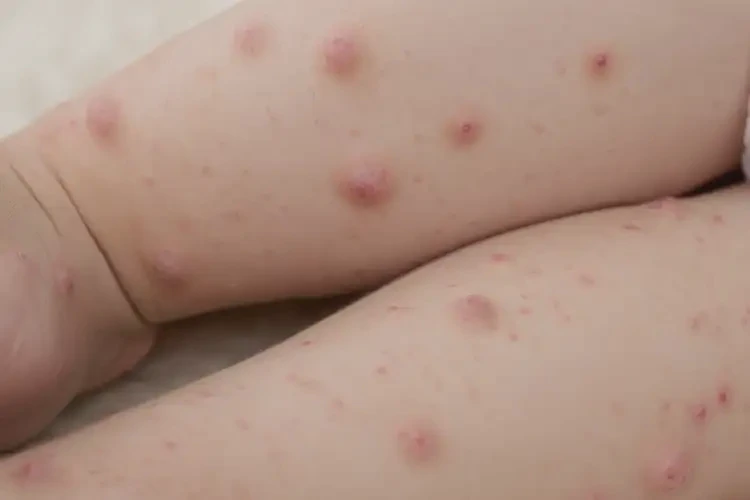 小儿四肢偶尔起湿疹不管它会自己自愈吗(图4)