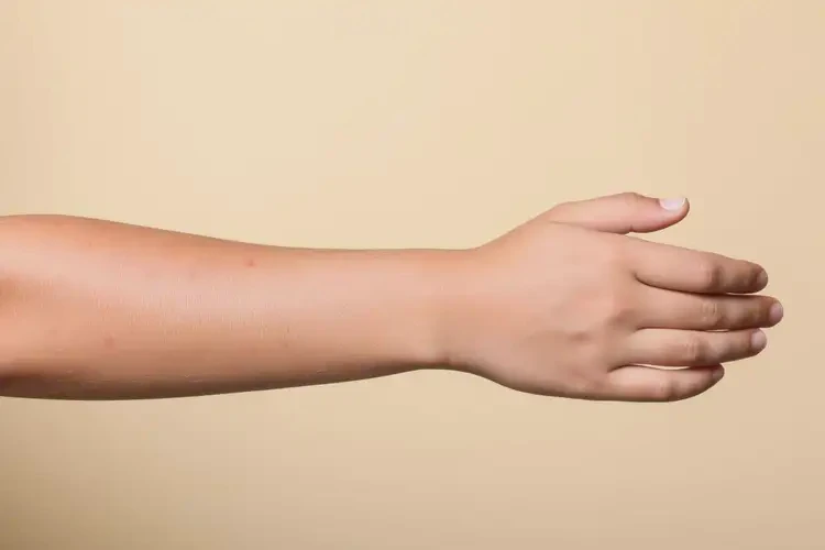 青少年手臂出現(xiàn)濕疹能靠自己自愈嗎(圖4)